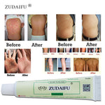 ZUDAIFU men women skin care product relieve Psoriasis Dermatitis Eczema Pruritus effect Without Retail Box Hot Selling